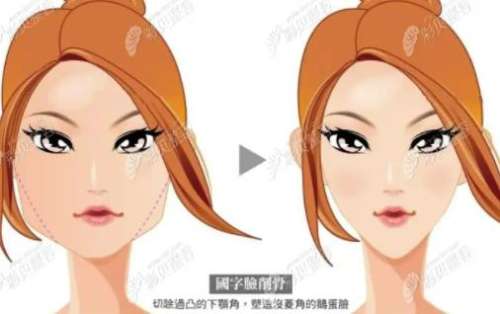 韩国颧骨颧弓降低术会导致皮肤下垂吗?