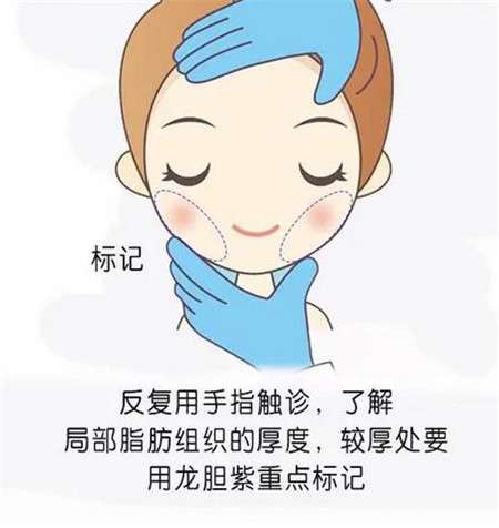 面部吸脂有效吗?会反弹吗